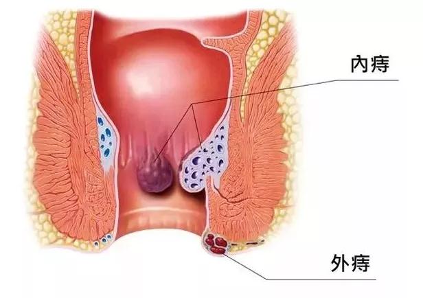 火锅吃的“好嗨哦” 谨防痔疮“C位出道”