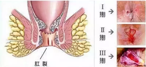 我的肛裂怎么还不愈合？