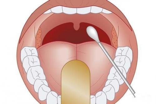 扁桃体肿大，说不出来话！扁桃体炎的病因都有哪些呢？