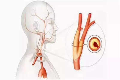 颈动脉斑块十分危险！应该怎样预防？