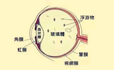 玻璃体混浊如何鉴别诊断