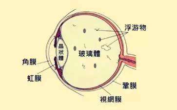 玻璃体混浊如何鉴别诊断