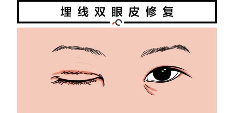 埋线双眼皮失败还能修复吗?修复的费用是多少?