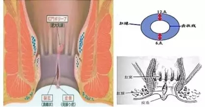 警惕肛裂!肛裂的病因有哪些？