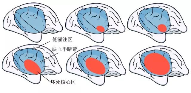 脑血管破裂前有信号，千万别等半身不遂才看！ 2019-09-12 06:33