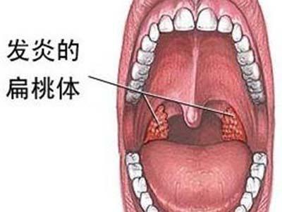 中医医生李文霞-扁桃体发炎怎么办