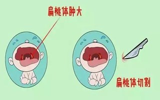 北京哪家医院治疗扁桃体肥大的比较好，日常如何预防扁桃体肥大