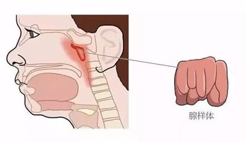 北京儿童医院做腺样体手术多少钱，腺样体肥大的症状表现有哪些?