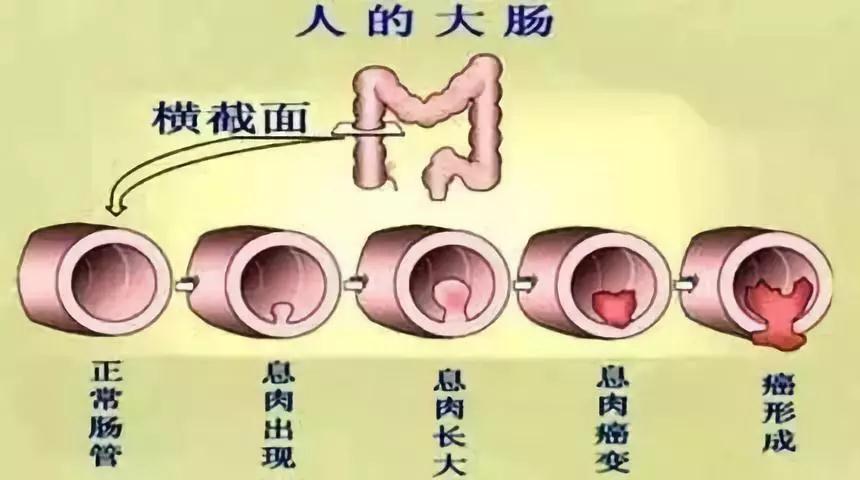 肠镜检查时肠道"干净"很重要,该如何做好肠道准备?