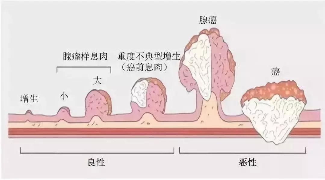 肠镜检查时肠道“干净”很重要，该如何做好肠道准备？