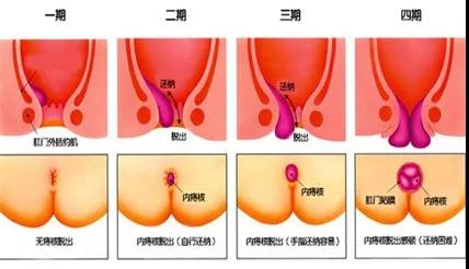 医生提醒：内痔一旦“放纵”，当心“辣手摧花”