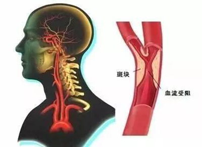 颈动脉斑块和3个因素脱不了关系！生活中一定要避免！