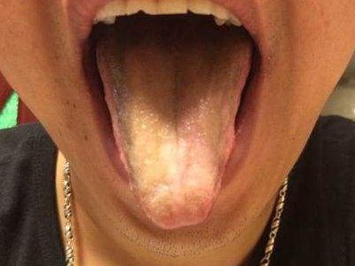口腔黏膜科李文霞主任-有哪些症状是舌炎呢？