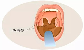 北京耳鼻喉比较好的医院，引起扁桃体炎的主要病因有那些呢？