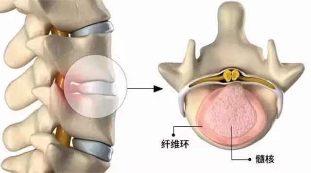 腰痛、腿麻、双腿没力，这是腰椎在呼救！