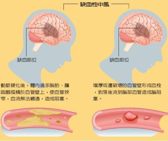 脑中风的发作时间一般是什么时候呢？