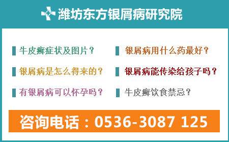 潍坊哪家医院治疗银屑病专业