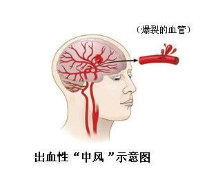 脑出血后康复治疗的方法有哪些呢？