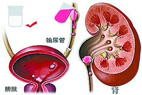 值得推荐的脑梗塞的护理方法