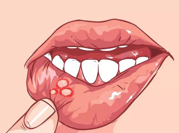 口腔粘膜病李文霞医生：有哪些原因会引发口腔溃疡的呢？