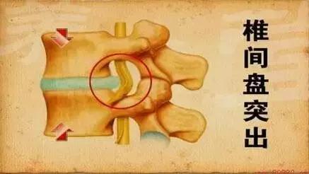 北京骨科医院排名,腰椎间盘突出的症状