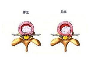 北京骨科医院排行,讲述缓解腰椎间盘突出症状要做好哪些工作？