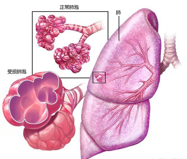 深入剖析肺气肿和肺心病的渊源，肺气肿的病因和症状！