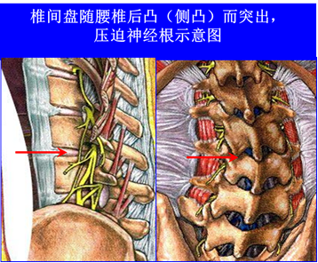 北京那个骨科医院,医师介绍腰椎间盘突出要注意哪些?