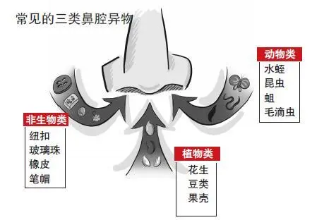 切莫忽视儿童鼻窦炎,以免影响孩子的求学之路