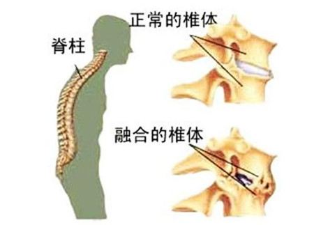 北京哪个医院治强直性脊柱炎好,医生介绍强直性脊柱炎的危害有哪些