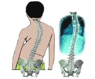 北京哪家医院治疗强制性脊柱炎医生讲述强直性脊柱畸形的症状