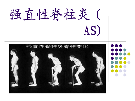 北京那个医院治强直性脊柱炎比较权威，女性强直性脊柱炎患者所具有的表现！