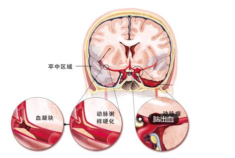 科普什么是脑梗塞