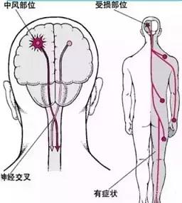 科普 |脑梗塞康复期太重要 一定要注意这三点