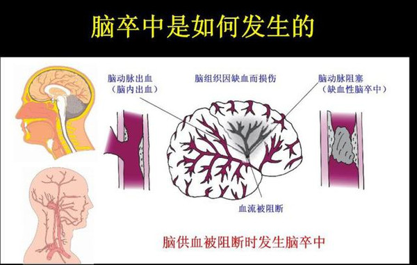 科普 |卒中后失语了还能恢复吗 怎么训练好呢