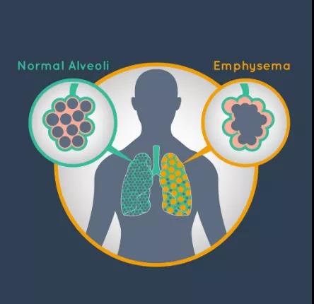 肺气肿产生的真确病因竟然不是肺！病因令人意外
