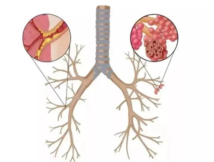 肺气肿产生的真确病因竟然不是肺！病因令人意外