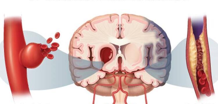 科普 |脑血栓应该如何治疗 饮食方面要注意