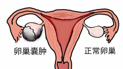 卵巢四类常见疾病致不孕