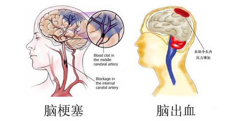 科普|老年人脑溢血应该怎么正确治疗