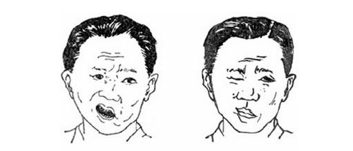 导致面瘫出现的重要原因是什么