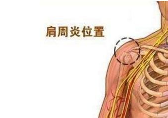 科普|老人肩周炎护理 这些方法就够了