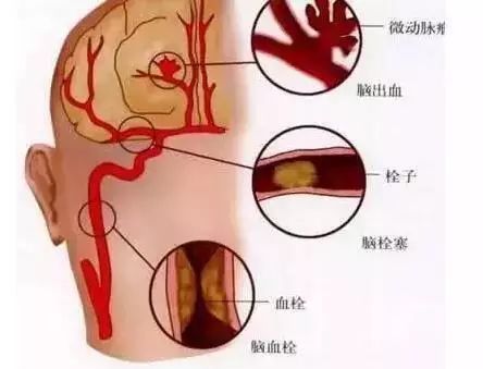 脑血栓患者怎么做康复训练