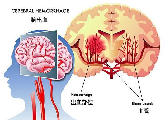 科普|脑出血康复有什么 要怎么做到