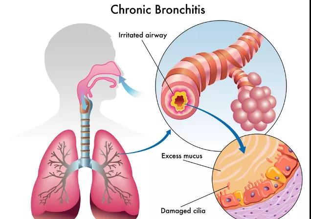 慢性支气管炎的日常饮食护理及如何用药
