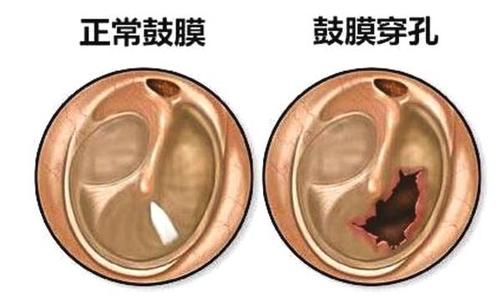 北京耳膜穿孔手术多少钱