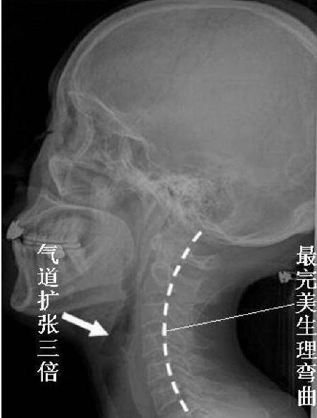 颈椎病浅谈