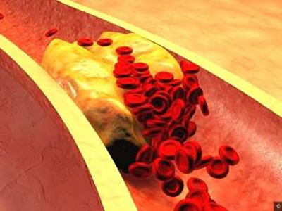 血液粘稠是血栓的前奏，四个症状预示出现血液粘稠
