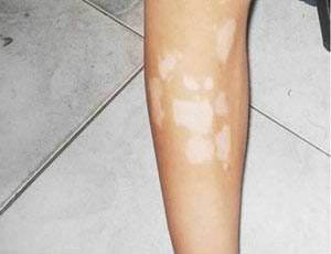 腿上长白斑的原因是什么？这5点来解答
