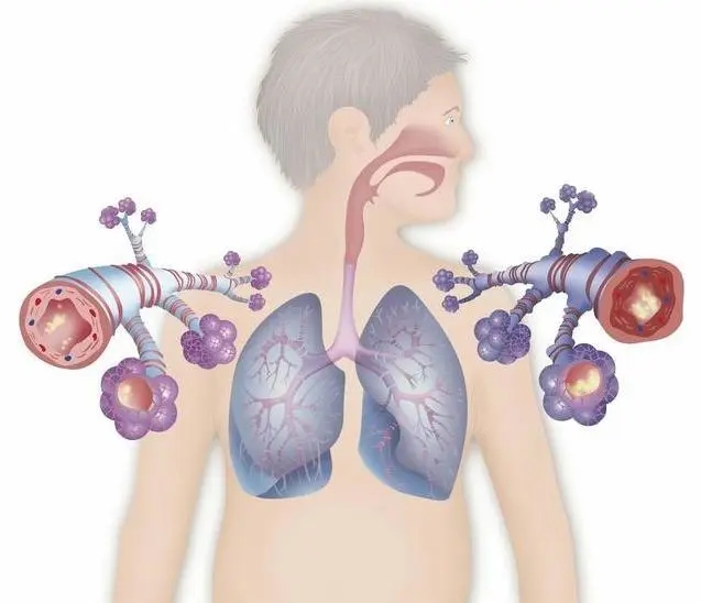 这3种状况是慢性支气管炎前兆，学会这些简单的调理方法对治疗很有帮助！